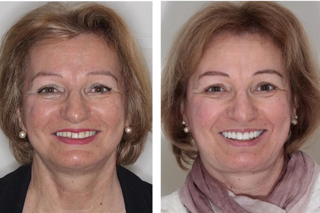 Before and after: woman rehabilitated with a fixed prosthesis on implants