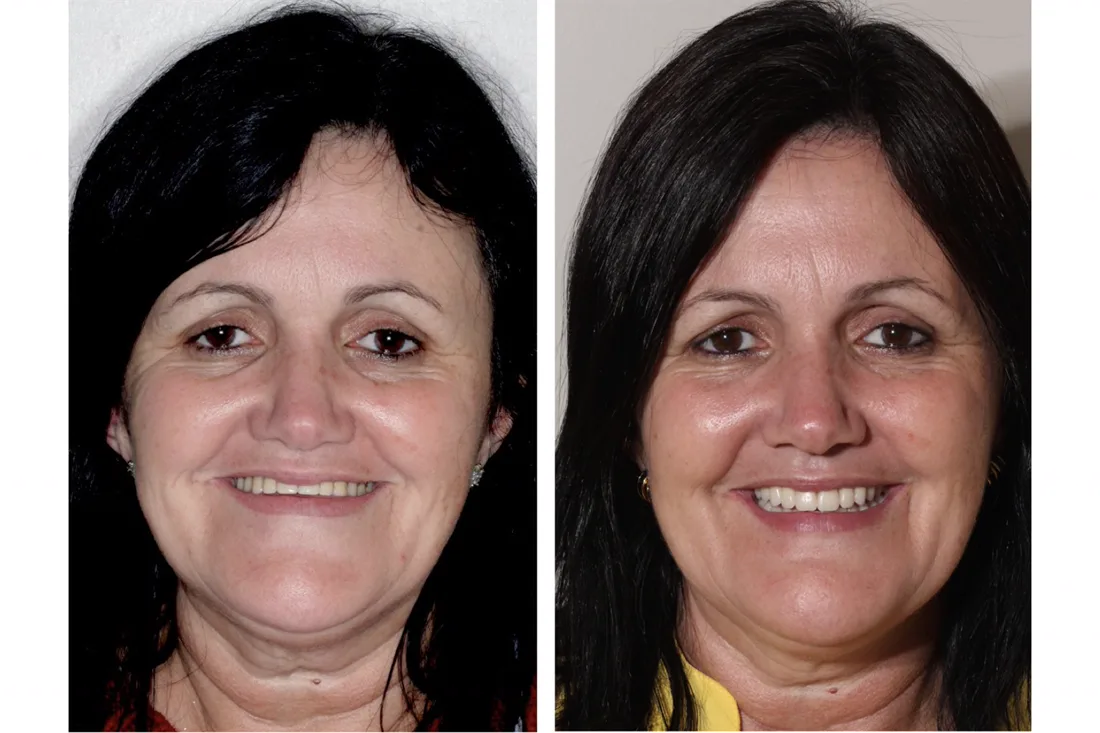 Before and after: woman with her smile restored by fixed teeth on implants