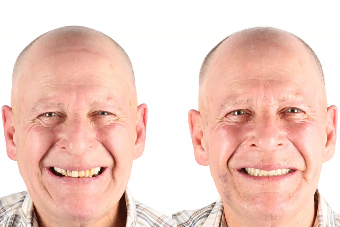 Before and after: a patient who travelled from Canada to Blumenau for fixed teeth on implants