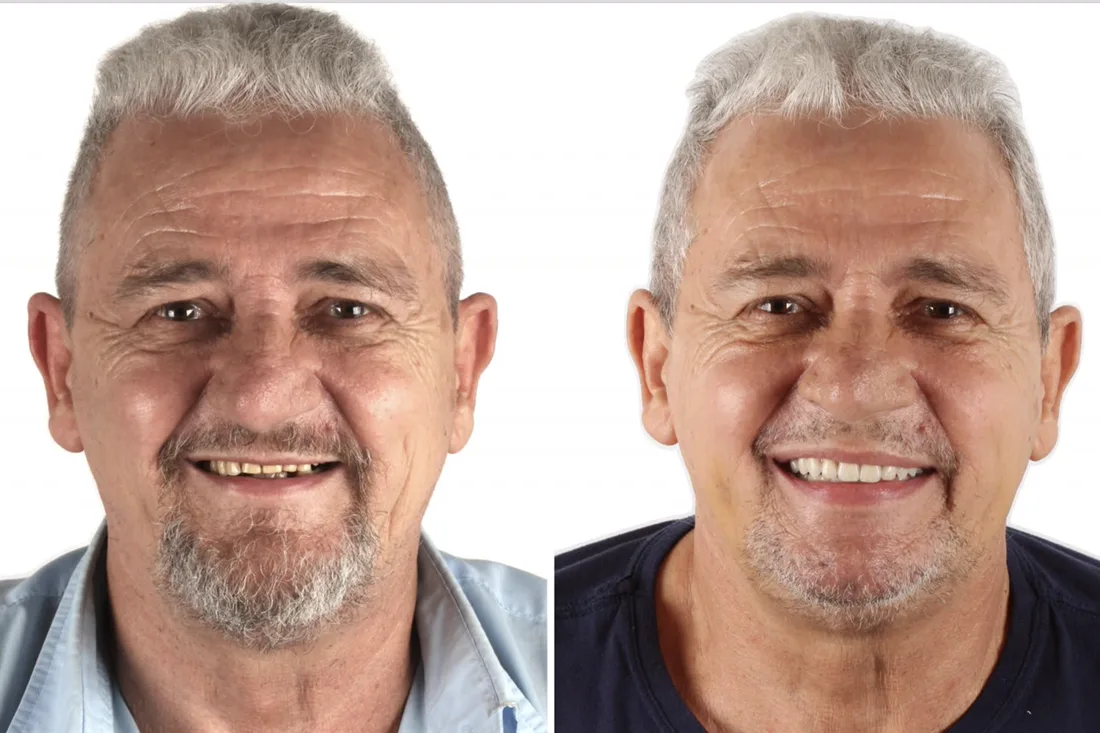 Before and after: man rehabilitated with zygomatic implants and the FaceFirst approach, smiling with fixed upper teeth
