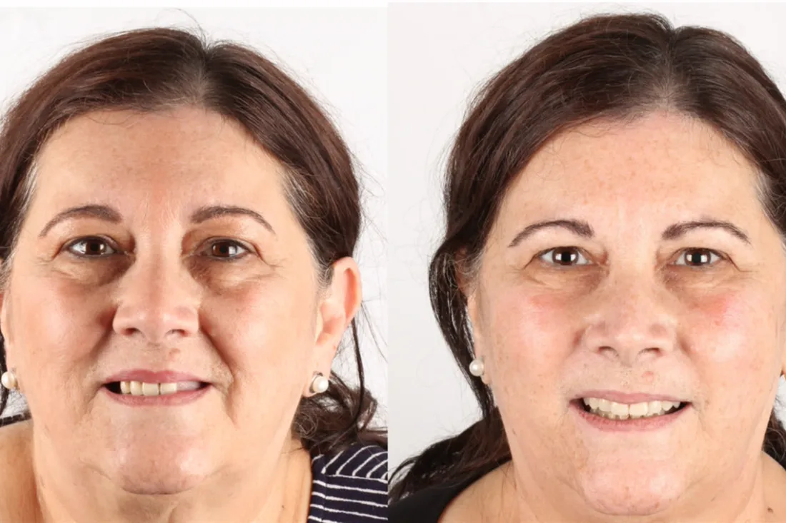 Before and after: a patient who travelled from the United States to Blumenau for fixed teeth on implants