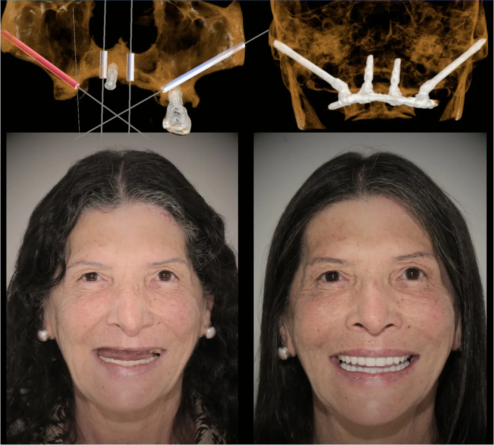 Top: the patient's CBCT with the planned implant positions and the X-ray after surgery showing two long zygomatic implants and two conventional implants carrying one bridge. Bottom: the patient before and after, smiling with fixed upper teeth