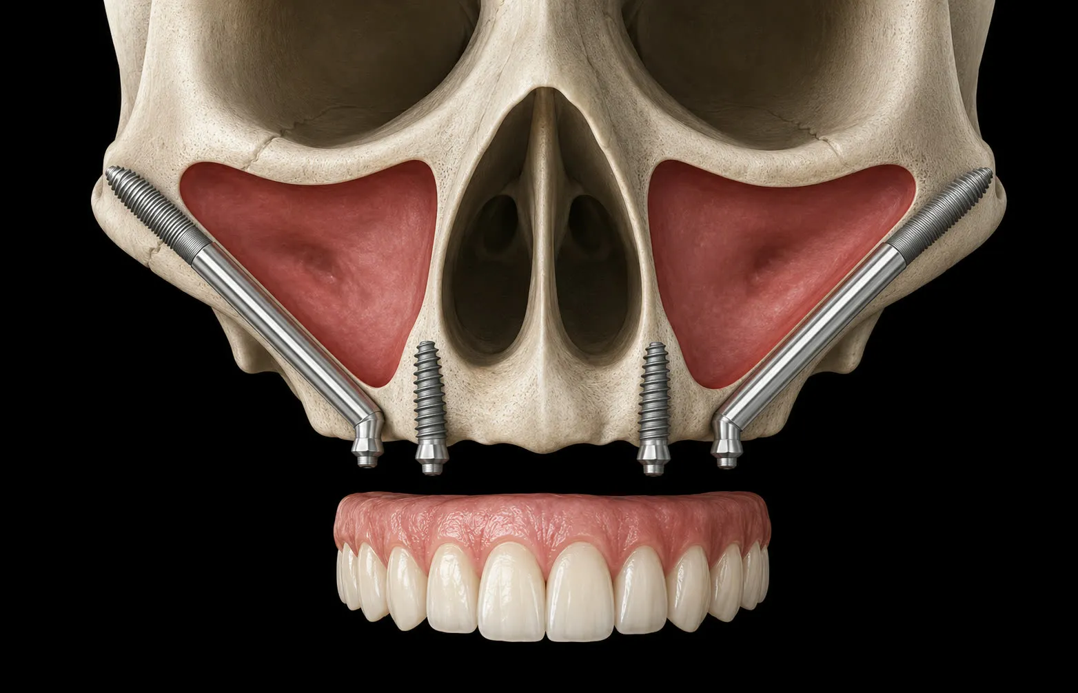 Illustration: two long zygomatic implants anchored in the cheekbones, two conventional implants at the front of the upper jaw, and a full fixed upper bridge beneath them