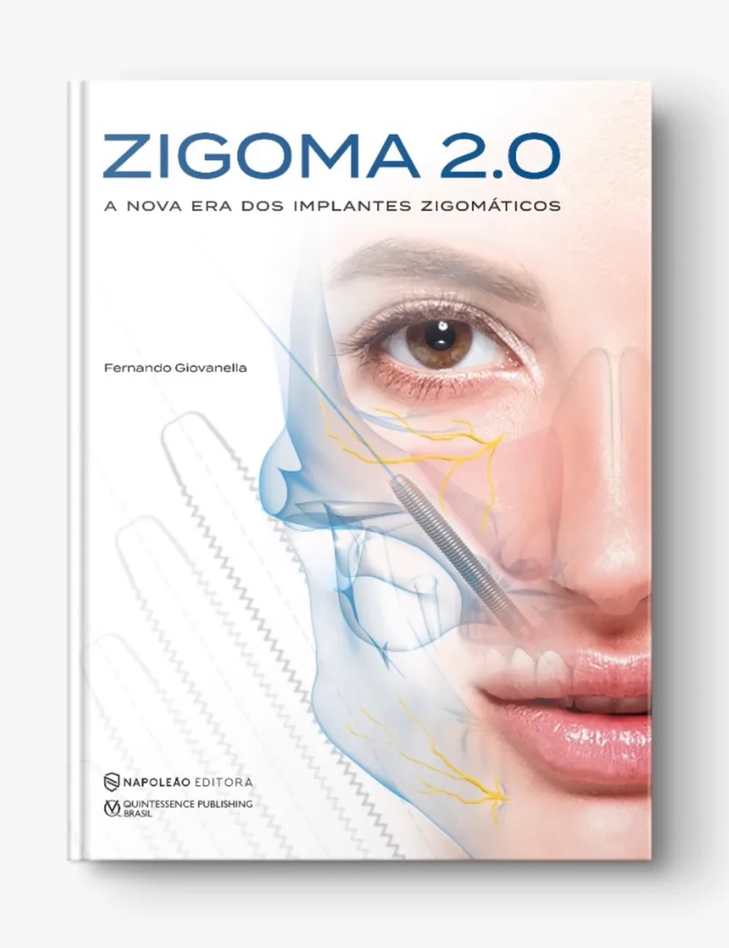 Capa do livro ZIGOMA 2.0 — A nova era dos implantes zigomáticos, de Fernando Giovanella