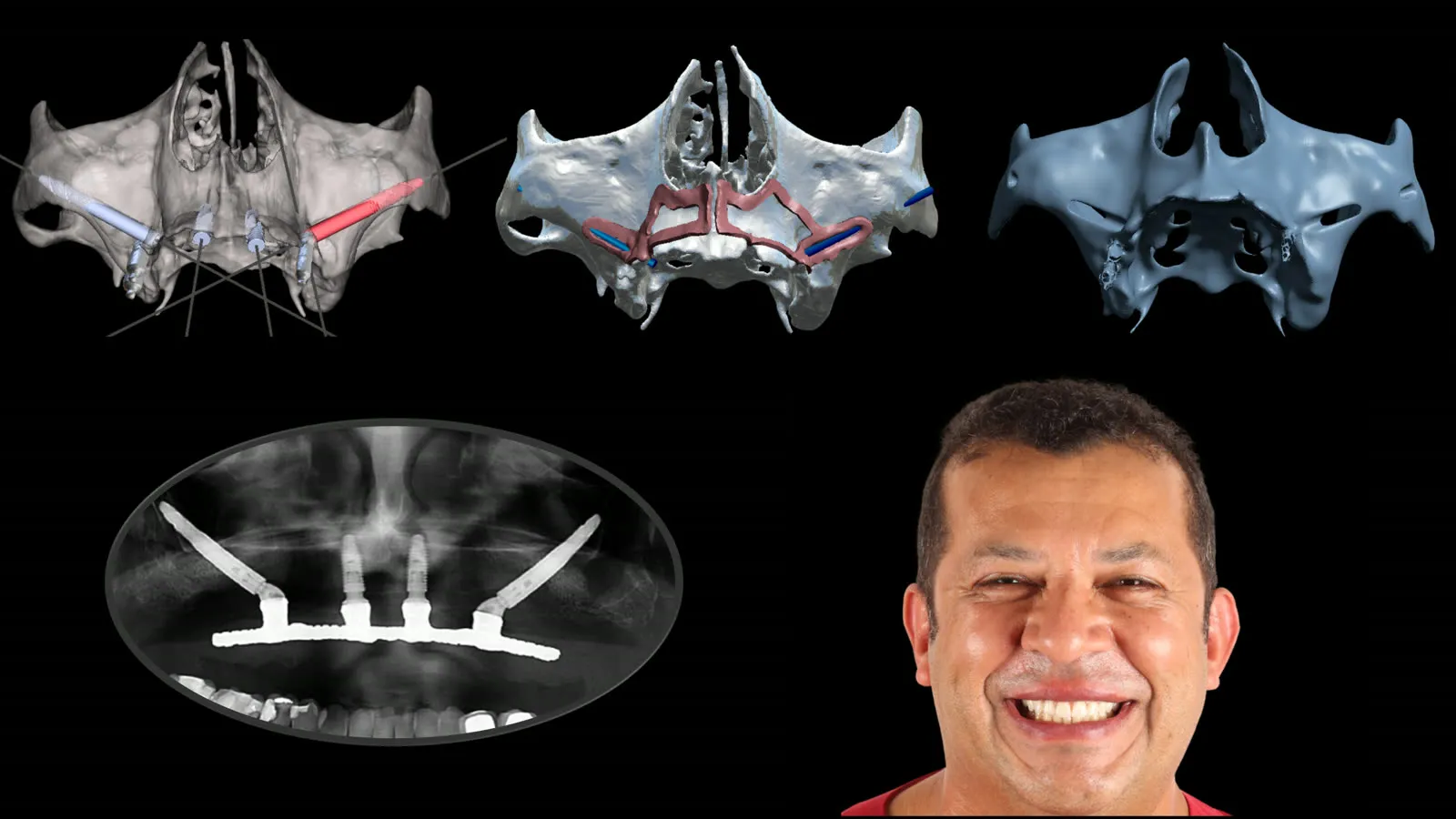 One case from scan to smile: the 3D model of the upper jaw with the planned implant paths, the surgical plan, the printed model, the X-ray after surgery with zygomatic implants, and the patient smiling